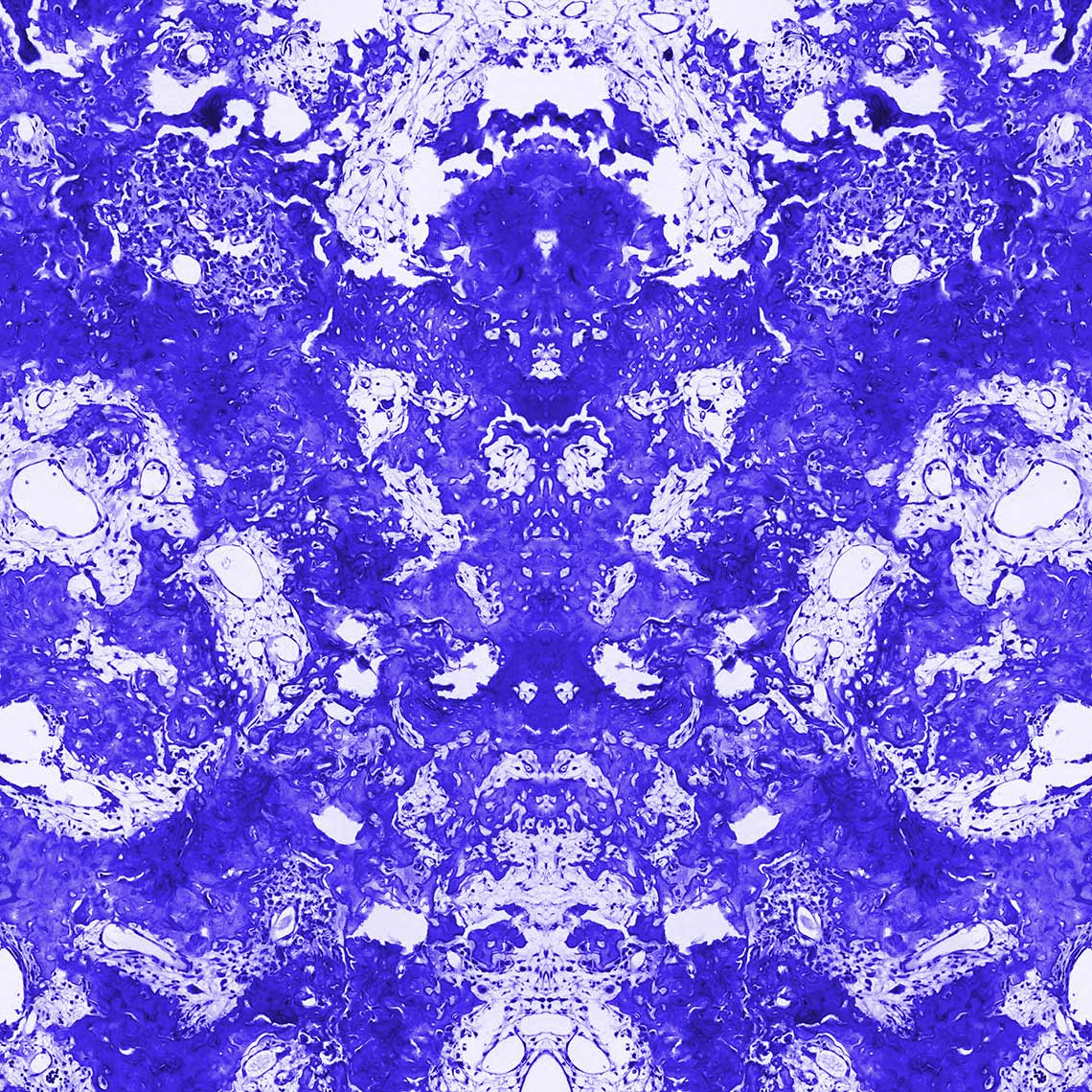 Blue Osteosarcoma LAUMONT