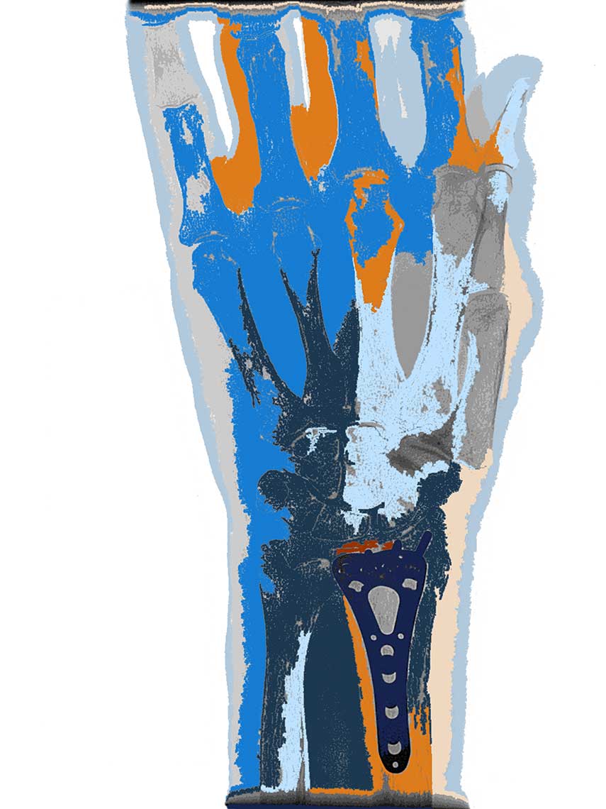 Hand-Implant-color-work
