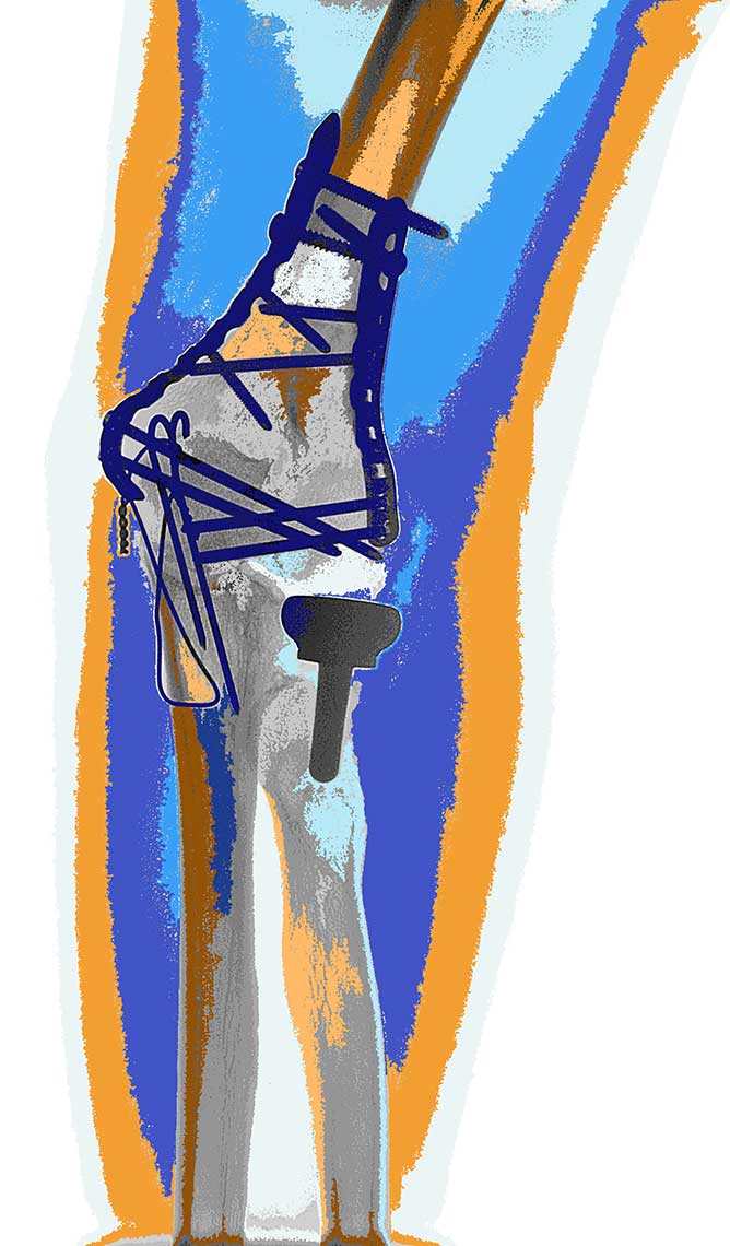 Rotator cuff posterized work color I